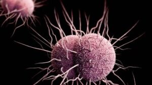 gonorrhea