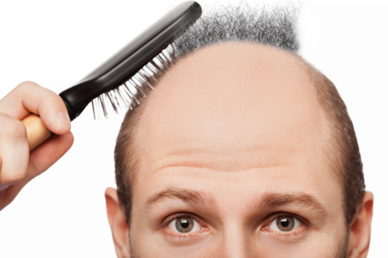 Bald Men Being Cured by Pubic Hair Transplants