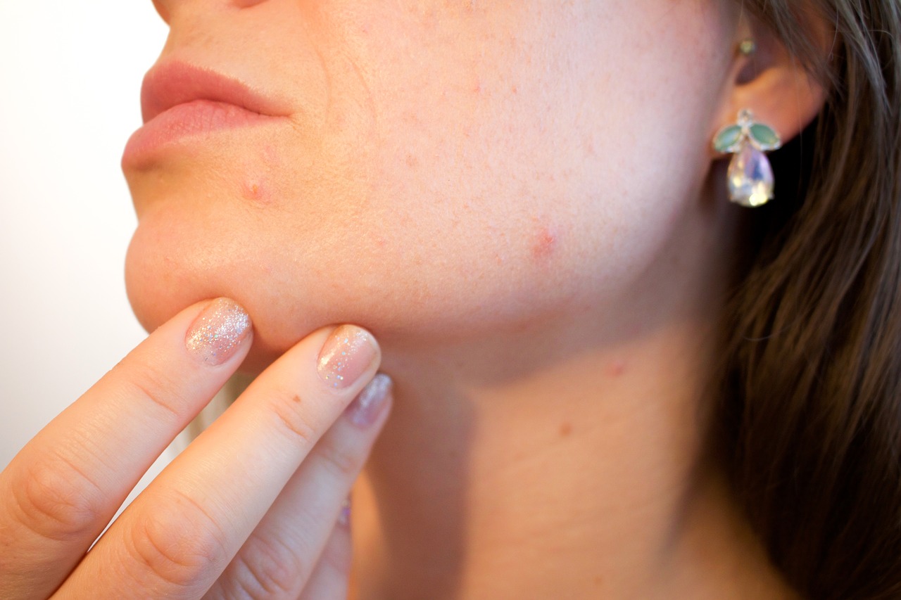 acne- skincare