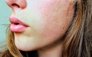 pexels-jenna-hamra-248942-1138531 skin diseases lichen sclerosus